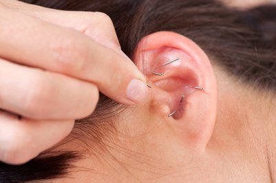 Öronakupunktur, akupunktur med nålar och kulplåster